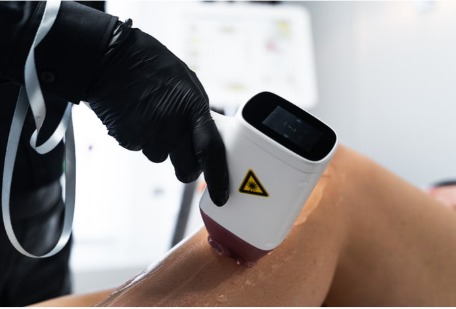 Behandlung mit dem Diodenlaser Derma Select Pro am Bein